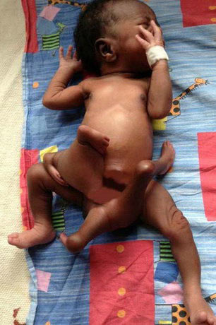 Scary-baby-born-with-8-limbs-Photo1