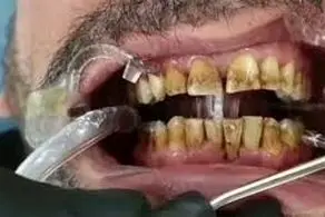 روش‌های خانگی برای محو کردن جرم دندان