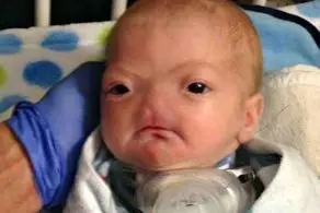 تولد نوزاد جنجالی که دماغ نداشت + عکس