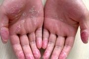 درمان فوری و آسان پوست پوست شدن دست