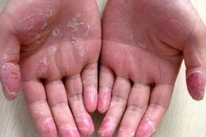 درمان فوری و آسان پوست پوست شدن دست