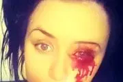 از چشم‌های این دختر بیچاره خون می‌چکد!+عکس