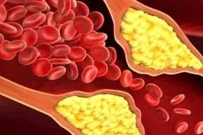 با خاص‌ترین علامت ابتلا به کلسترول خون بالا آشنا شوید
