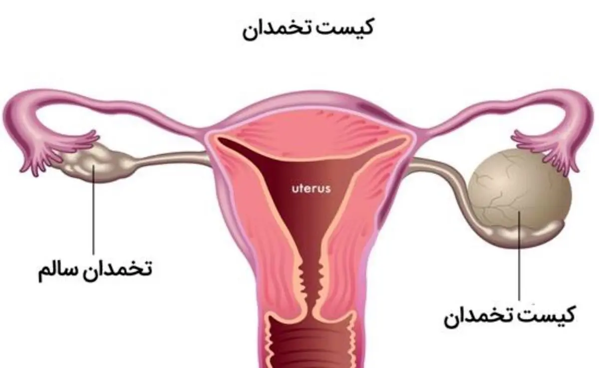 درمان سه سوته کیست تخمدان