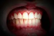 دلایل خونریزی لثه در هنگام استفاده از نخ دندان طبیعی است؟