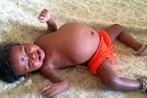 پیدا شدن یک جنین در شکم دختر 15 ماهه + عکس