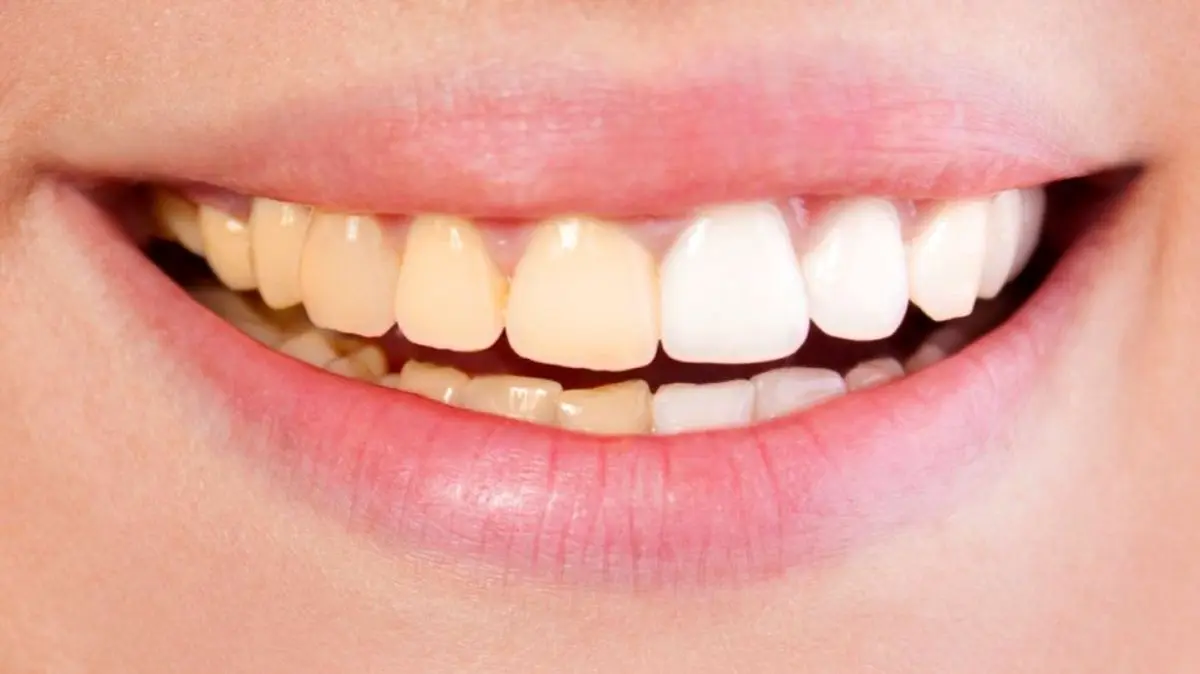 راهکار درمان دندان درد کشف شد + درمان های خانگی