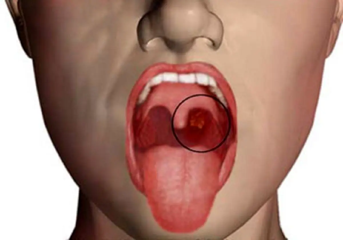 این علایم خطرناک در دهان از ابتلا به سرطان خبر می‌دهند
