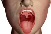این علایم خطرناک در دهان از ابتلا به سرطان خبر می‌دهند
