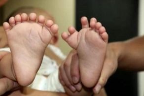 تولد نوزاد عجب الخلقه با 31 انگشت+ عکس