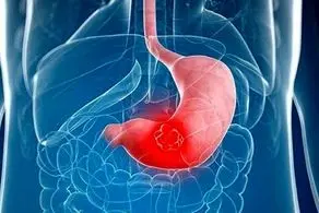 پیشگیری از سرطان معده با این میوه