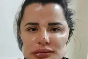 خرابکاری شرم‌آور دکتر ناشی روی صورت بیماران!+عکس