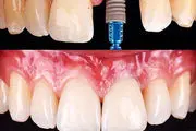 متخصص ایمپلنت کیست | معرفی انتخاب بهترین متخصص ایمپلنت