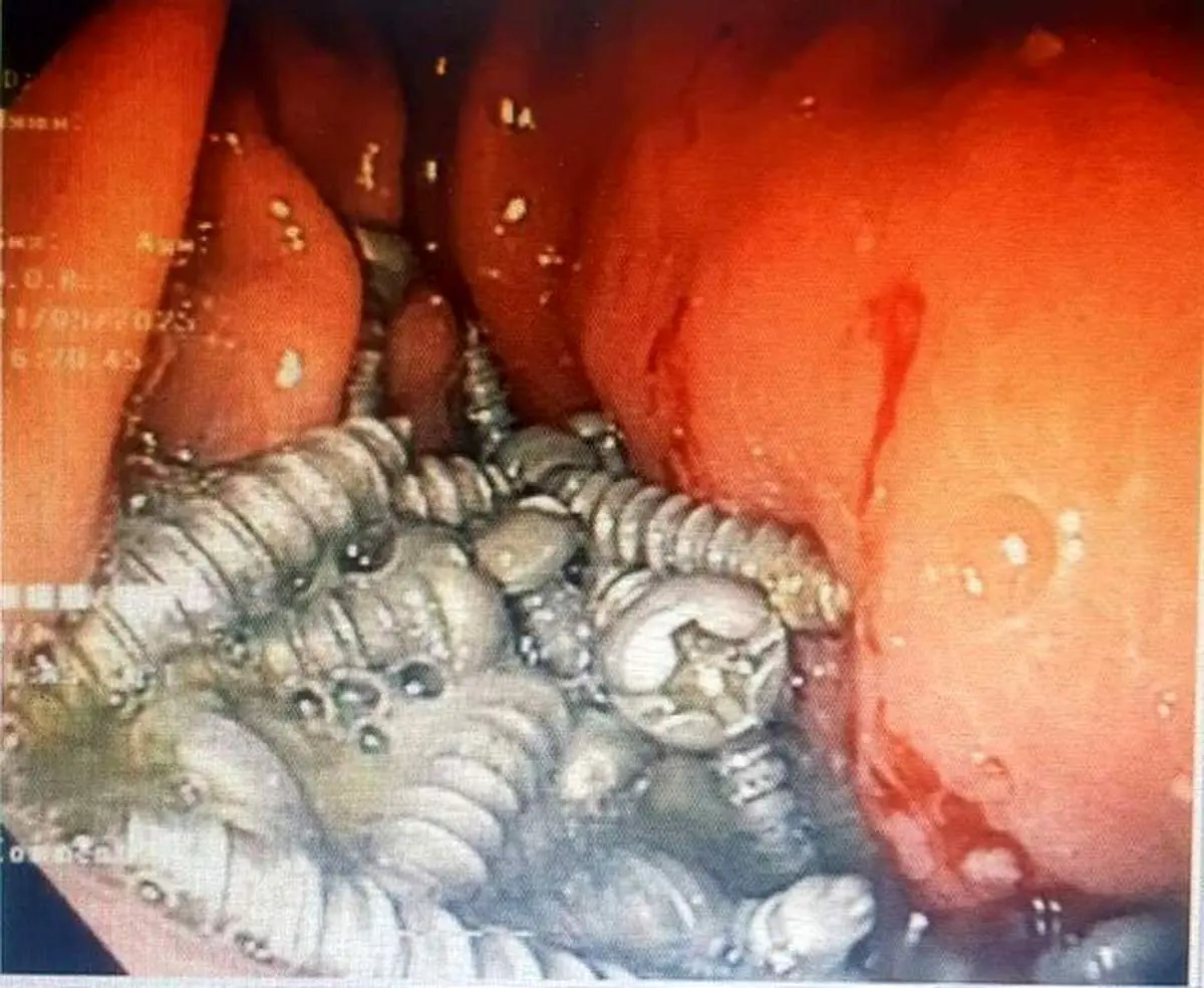 خروج ۴۷ پیچ از معده یک بیمار در کرج بدون جراحی!