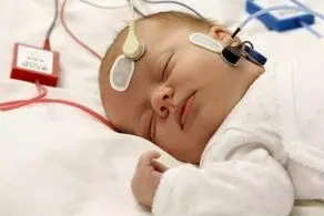 چهره عجیب این نوزاد هنگام تولد همه پزشکان را ترسناد/ عکس