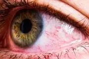 عفونت چشم هم از علائم کرونا است؟