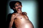 مرد هندی حامله شد و این موجود را زایید!/ عکس